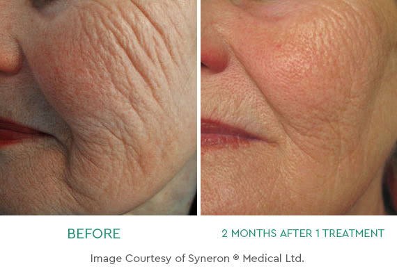 Fight Back Against Aging Skin with Profound® RF Skin Tightening